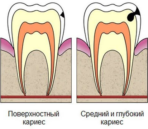 Пульпит Молочных Зубов Фото