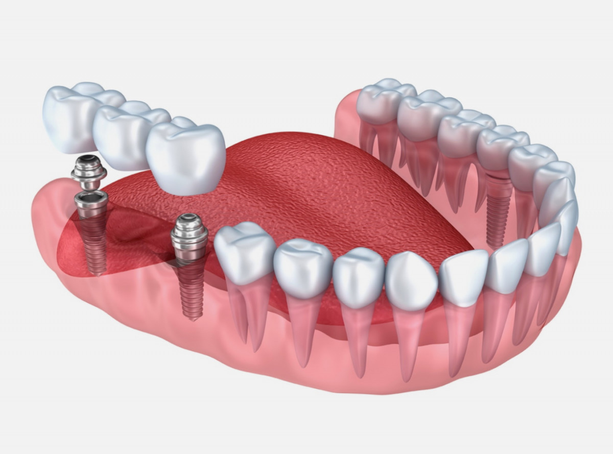 lechenie-i-protezirovanie-zubov